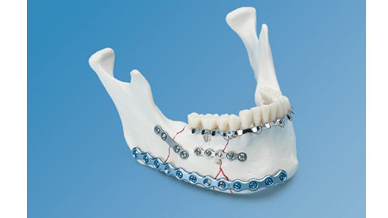 MatrixMANDIBLE™ Plating System | DePuy Synthes